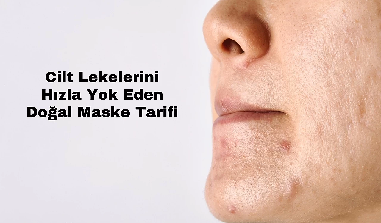 Cilt Lekelerini Hızla Yok Eden Doğal Maske Tarifi