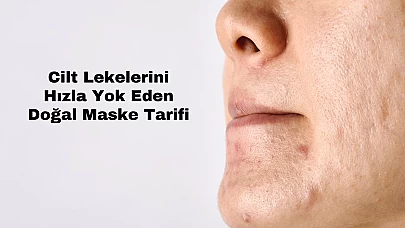 Cilt Lekelerini Hızla Yok Eden Doğal Maske Tarifi