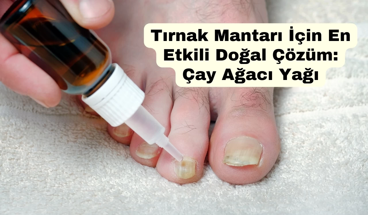 Tırnak Mantarı İçin En Etkili Doğal Çözüm: Çay Ağacı Yağı